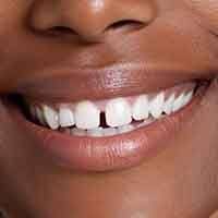 Up-close view of a gap between two front teeth