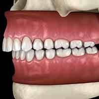Image of an overbite