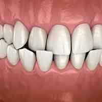 Crossbite with teeth overlapping