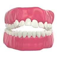 Front upper and lower teeth not touching