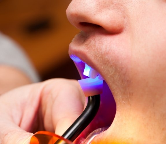 Close up of dental patient getting cosmetic dental bonding on an upper front tooth