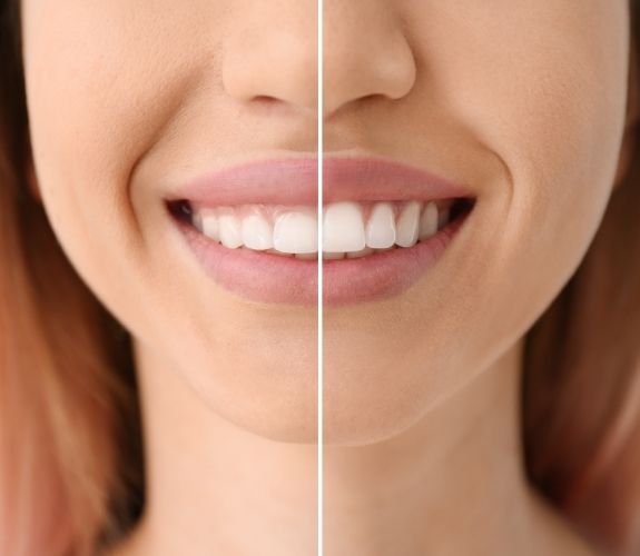 Close up of smile before and after fixing gummy smile with gum recontouring