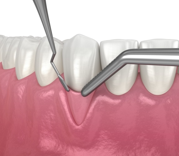 Illustration of small amount of gum tissue being removed