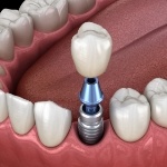 Illustrated dental crown being placed onto a dental implant