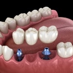 Illustrated dental bridge being placed onto two dental implants