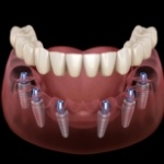 Illustrated denture being placed onto six dental implants