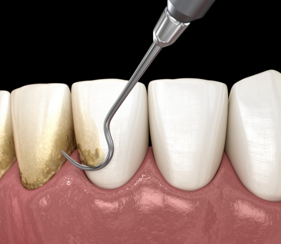 Illustrated dental tools cleaning plaque from teeth during gum disease treatment