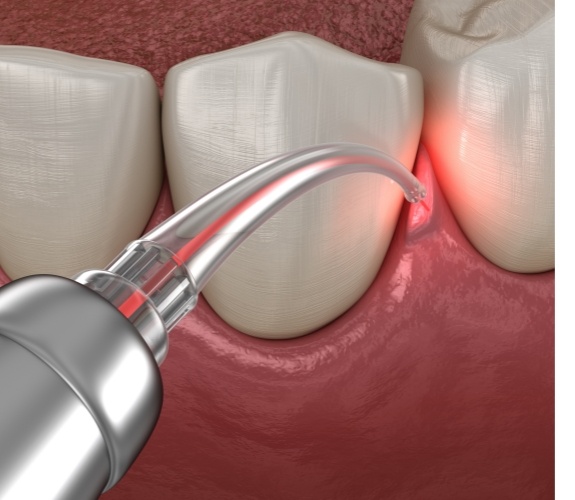 Illustrated dental laser treating gum disease