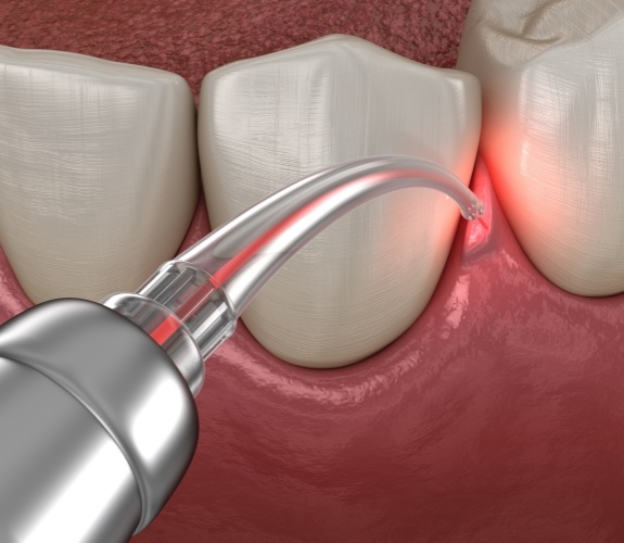 Illustrated dental laser treating gum disease