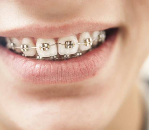 Close up of a person with braces grinning