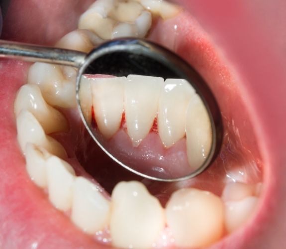 Close up of dental mirror inside of mouth