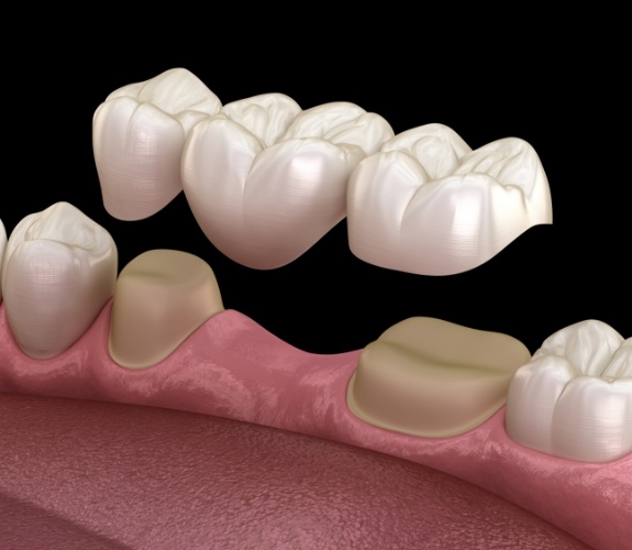 Illustrated dental bridge replacing a missing tooth