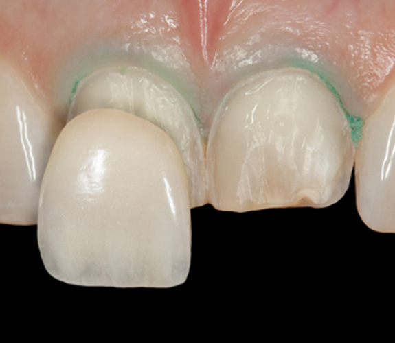 Up-close view of dental veneers 
