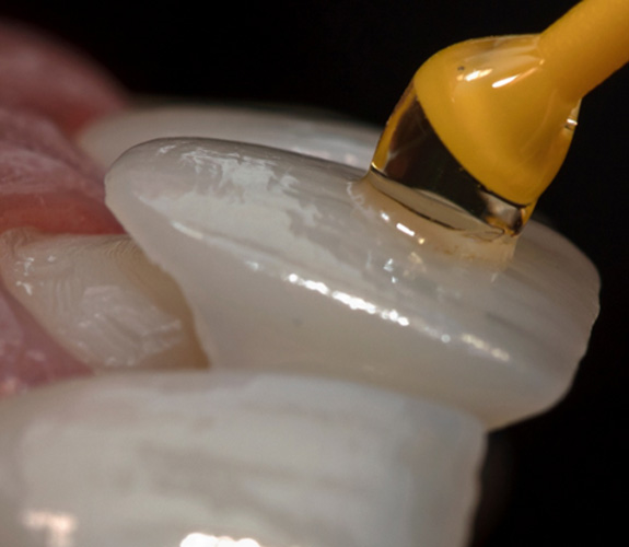 Dentist placing dental veneers on a patient’s teeth 