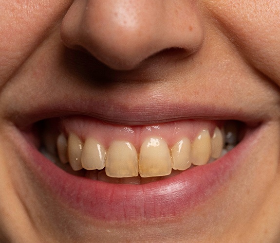 Up-close image of a person’s stained teeth